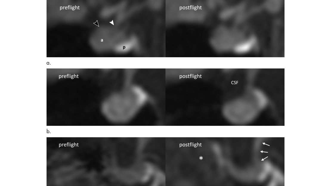 These are examples of changes in astronauts' pituitary glands after spaceflight.