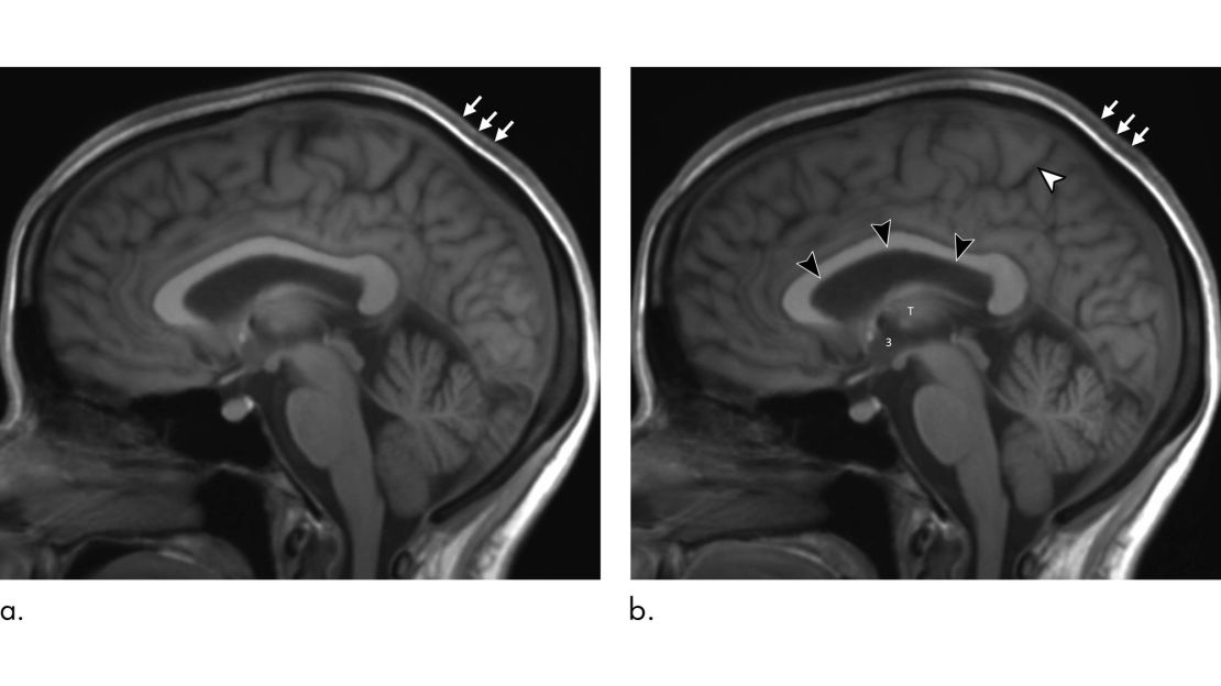 A comparison of an astronaut's brain before (left) and after long-term spaceflight shows the expansion of brain volume.