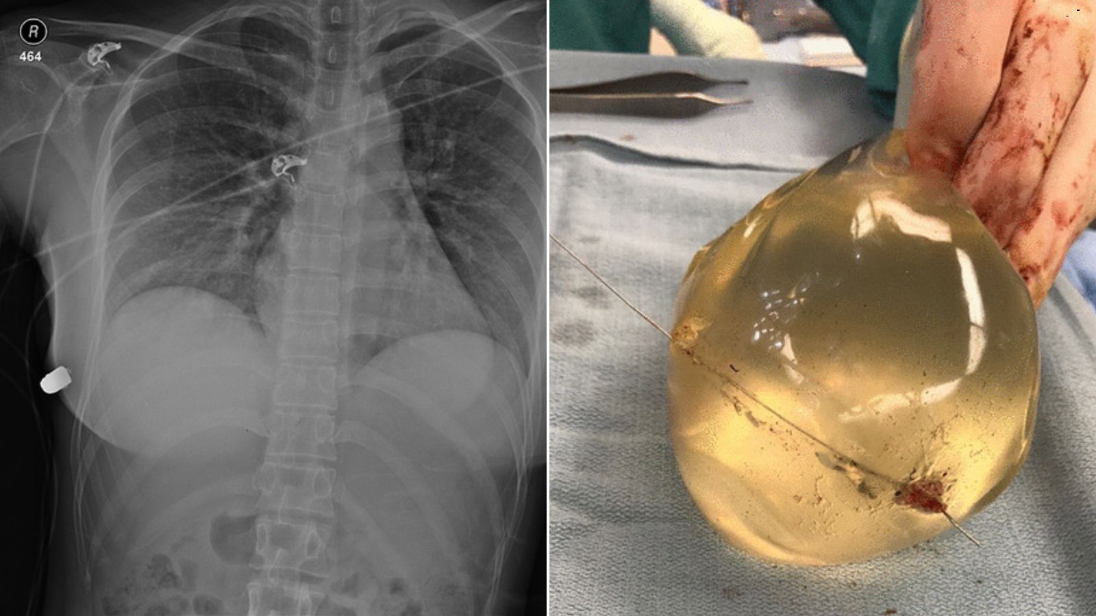 Mum BURST her own breast implants with enormous needle used for