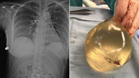 Doctors believe the woman's life was saved because of her implants, which affected the trajectory of the bullet.