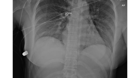 An X-ray showing the bullet in the lateral thoracic wall.