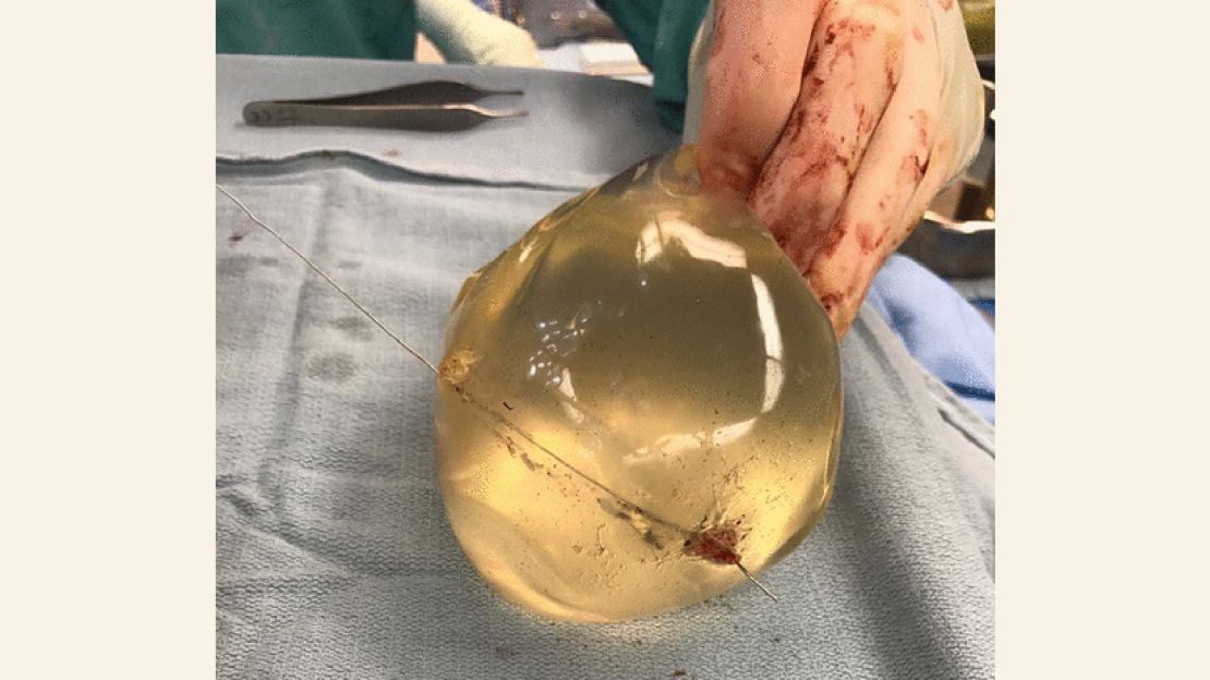 Intraoperative view of left breast implant showing bullet trajectory through implant.