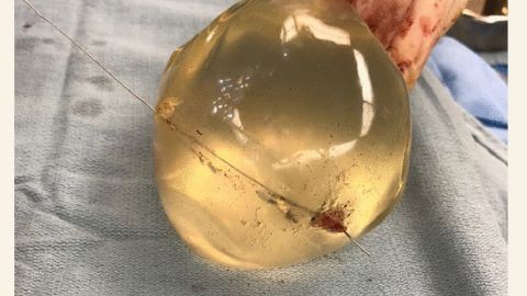 Intraoperative view of left breast implant showing bullet trajectory through implant.