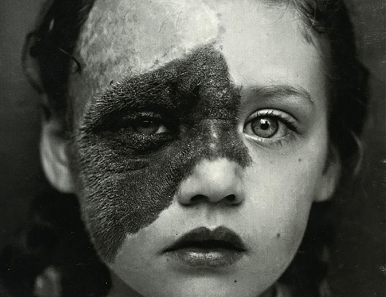 A photo of a girl with a "Utrechtse Krop" (Utretch goiter) -- a thyroid condition common in the Dutch city in the 19th century, when local drinking water was deficient in iodine.
