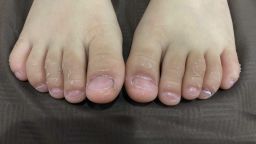 Symptom of kawasaki disease 