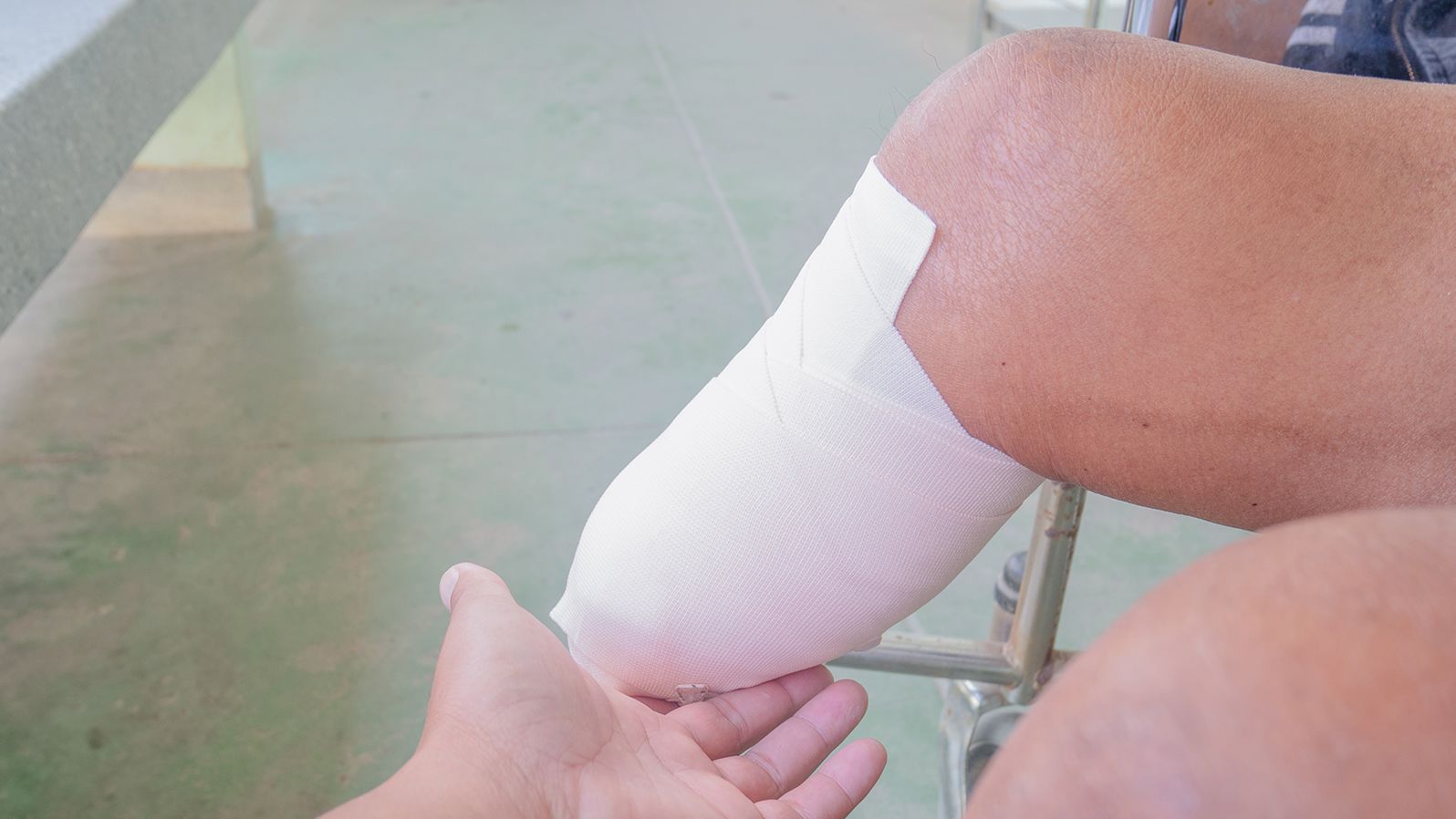 A patient with a bandaged leg following an amputation