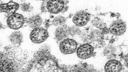 This 2020 electron microscope made available by the U.S. Centers for Disease Control and Prevention image shows the spherical coronavirus particles from the first U.S. case of COVID-19. On Monday, May 4, 2020, New York City health authorities issued an alert to doctors about severe inflammatory condition possibly linked with COVID-19 has been found in a cluster of U.S. children in New York City after first being reported in Europe. On Wednesday, New York said 64 potential cases had been reported to the state. Fever, abdominal pain and skin rashes are common symptoms of the unnamed condition, which has features similar to Kawasaki disease and toxic shock syndrome. (C.S. Goldsmith, A. Tamin/CDC via AP)
