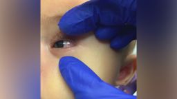 Bulbar conjunctival injection is shown in the case study of a 6-month-old infant admitted and diagnosed with classic Kawasaki disease (KD), who also screened positive for COVID-19 in the setting of fever and minimal respiratory symptoms. 
