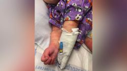 Upper extremity erythema and edema is shown in the case study of a 6-month-old infant admitted and diagnosed with classic Kawasaki disease (KD), who also screened positive for COVID-19 in the setting of fever and minimal respiratory symptoms.