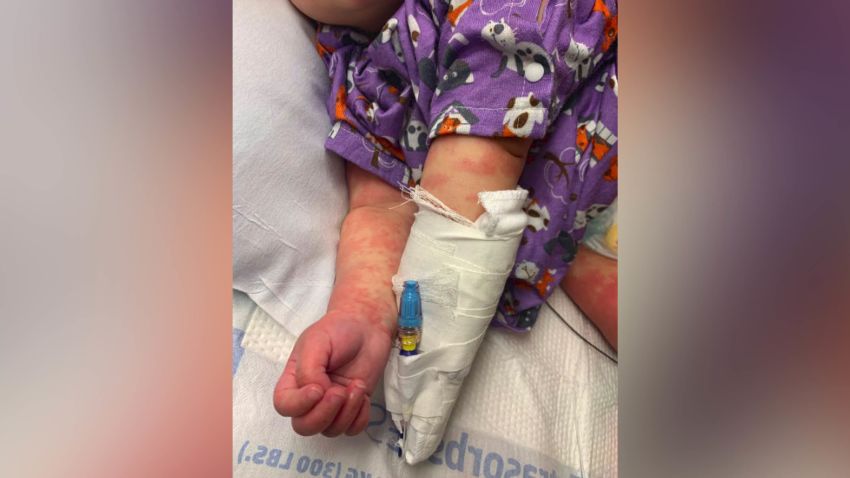 Upper extremity erythema and edema is shown in the case study of a 6-month-old infant admitted and diagnosed with classic Kawasaki disease (KD), who also screened positive for COVID-19 in the setting of fever and minimal respiratory symptoms.