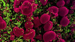 Colorized scanning electron micrograph of an apoptotic cell (pink) heavily infected with SARS-COV-2 virus particles (green), isolated from a patient sample. Image captured at the NIAID Integrated Research Facility (IRF) in Fort Detrick, Maryland. NIAID