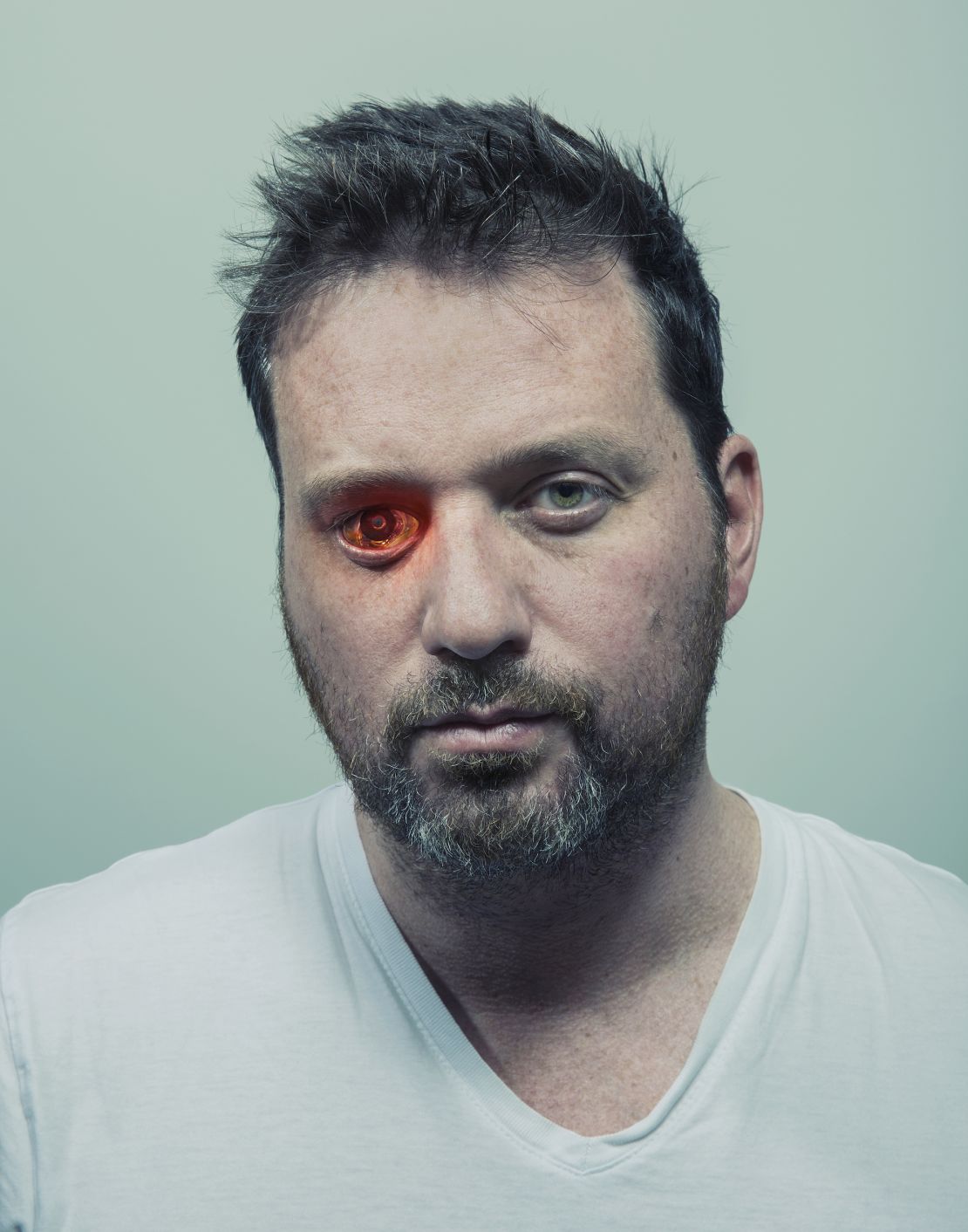 Describing himself as an "eyeborg," Rob Spence installed a wireless video camera in place of his right eye.