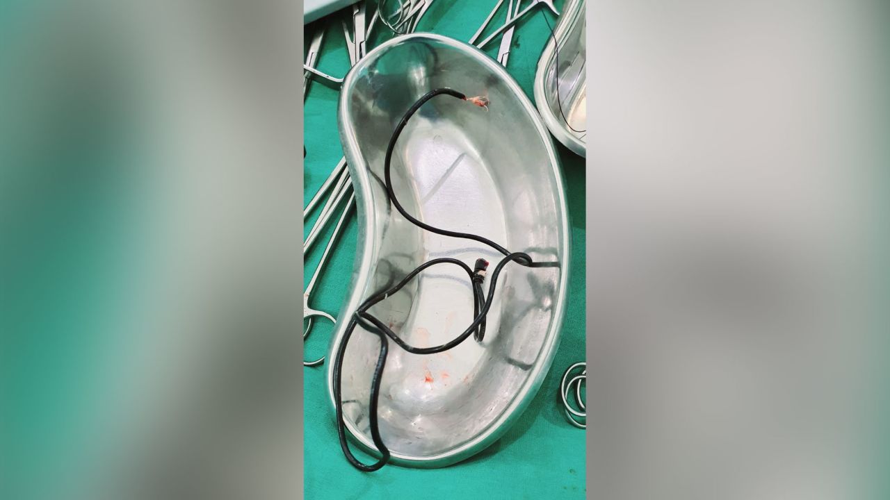 The patient initially told doctors he had swallowed some earphones.