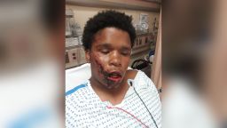 Bronx teenager Jahmel Leach suffered facial fractures after allegedly being tased by NYPD, his lawyer told CNN.