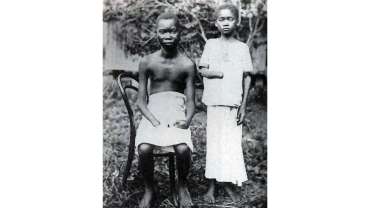 Amputation was frequently used to punish workers nad their families in the Congo Free State, controlled by King Leopold II of Belgium.