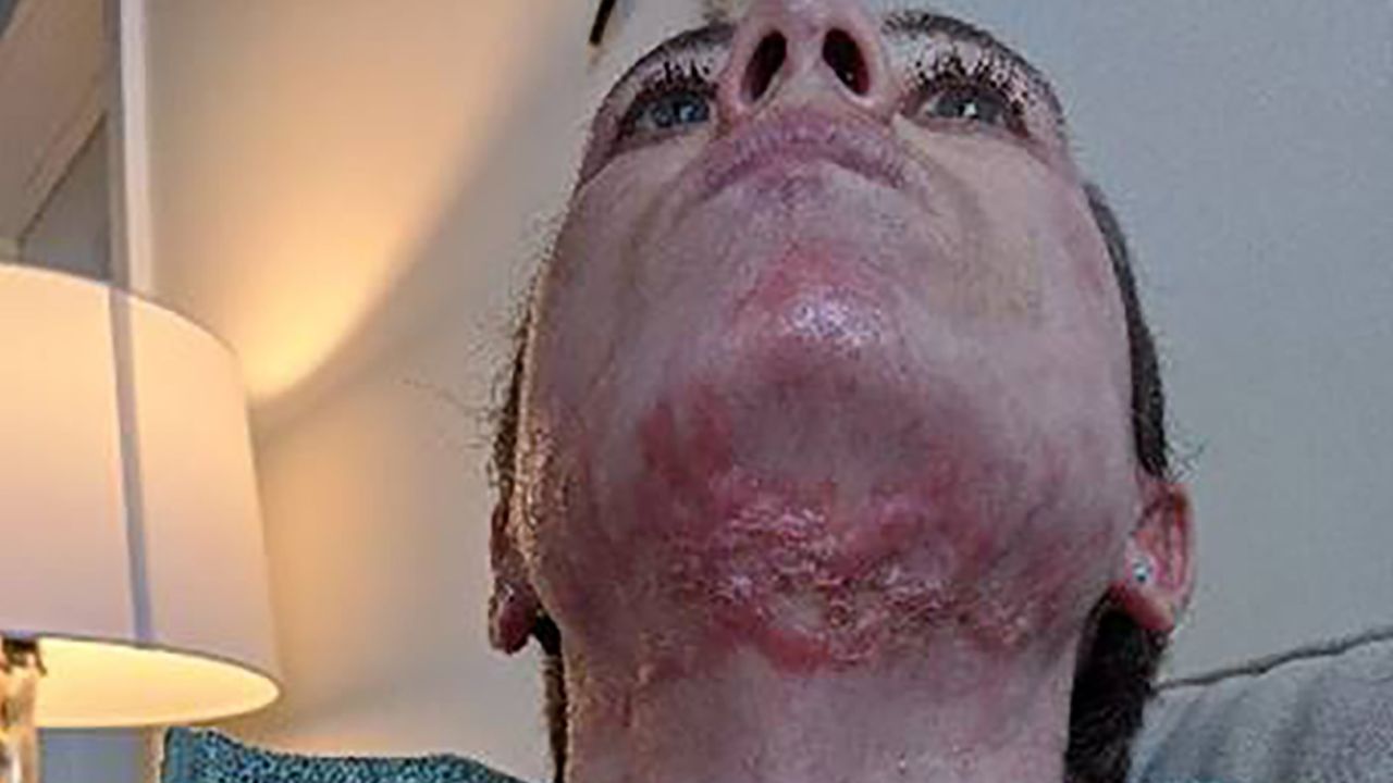 Some of Lauren Barham's injuries.