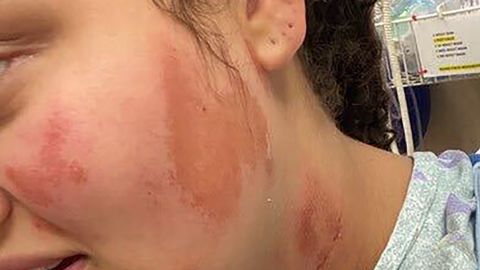 In this undated photo provided by the family of Althea Bernstein shows the burns on Bernstein's face an neck after four white men sprayed her with lighter fluid and threw a lighter at her.