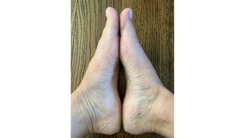 My feet before Baby Foot 