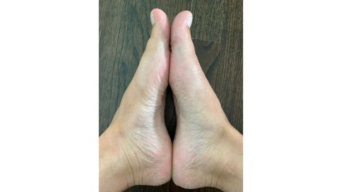 My feet after Baby Foot 