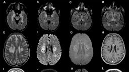 coronavirus brain damage study intl hnk scli scn