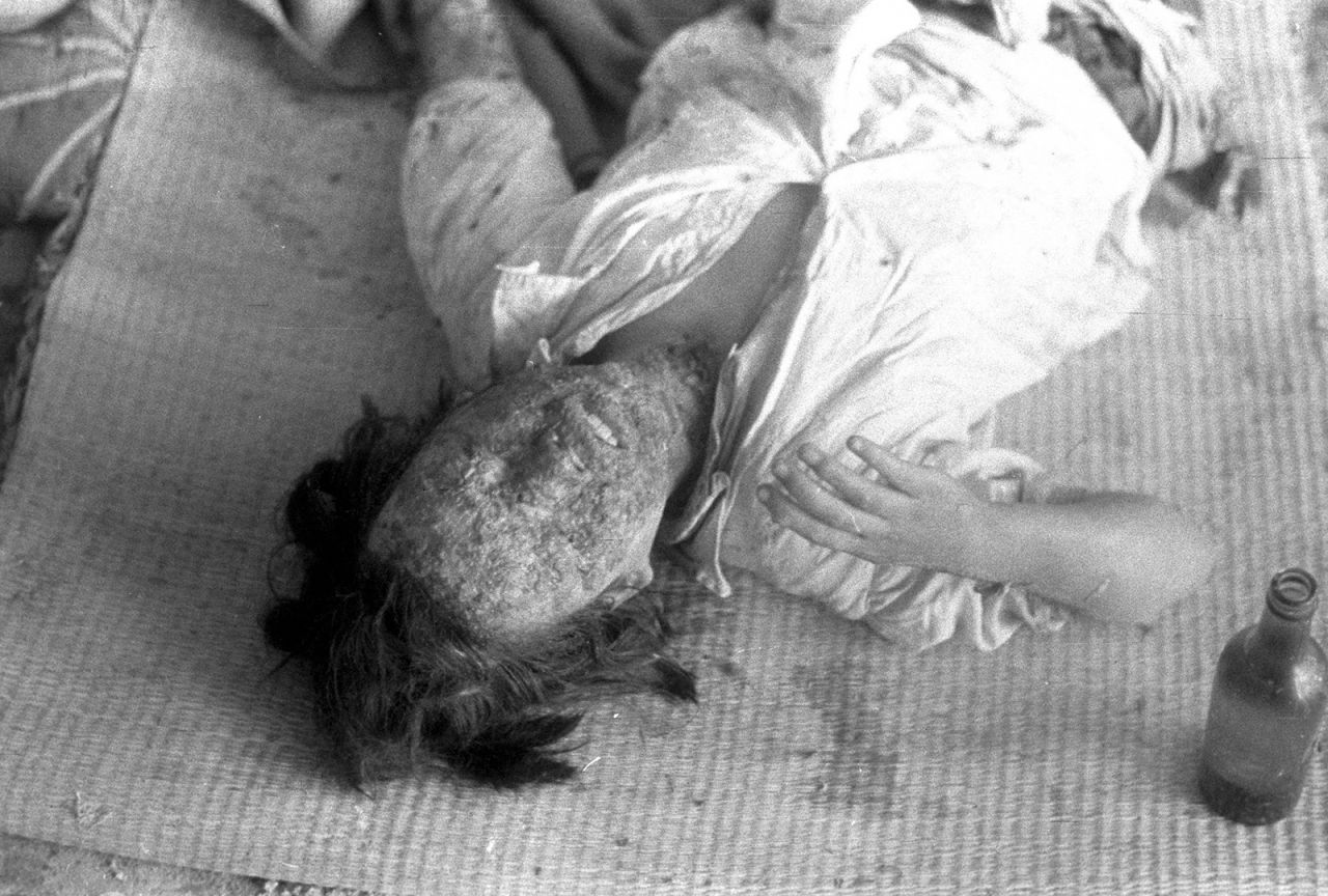 A patient suffering severe radiation burns lies in the Hiroshima Red Cross hospital in August 1945. Many of those who survived the initial blast died of severe radiation-related injuries and illnesses.