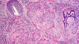 Cervical Cancer: Invasive squamous carcinoma arising in association with severe squamous dysplasia (CIN III, HSIL), related to HPV (human papilloma virus).