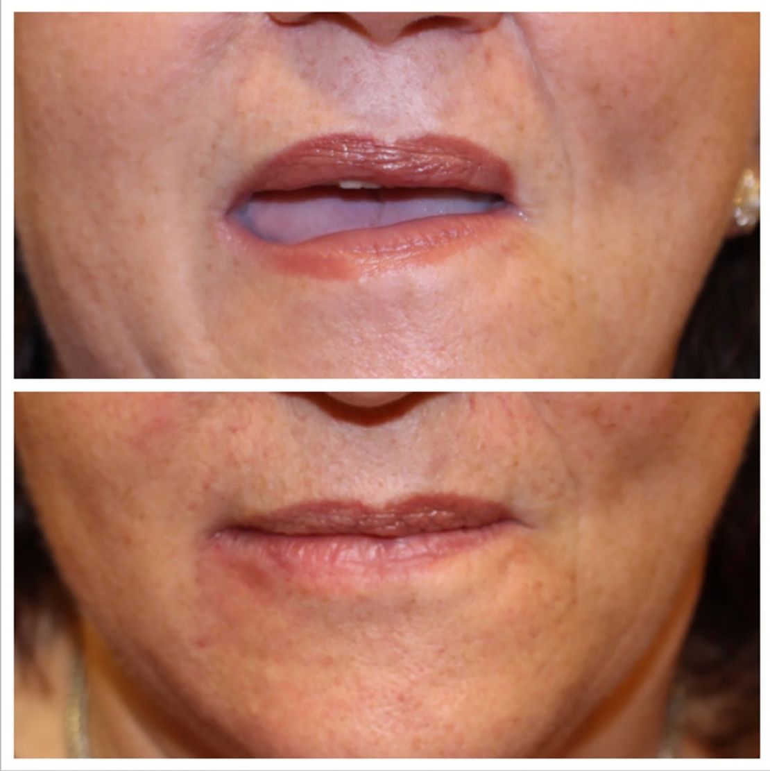 Research by Massachusetts Eye and Ear's Facial Nerve Center, part of Harvard Medical School, used facial filler injections to help patients with Bell's palsy.