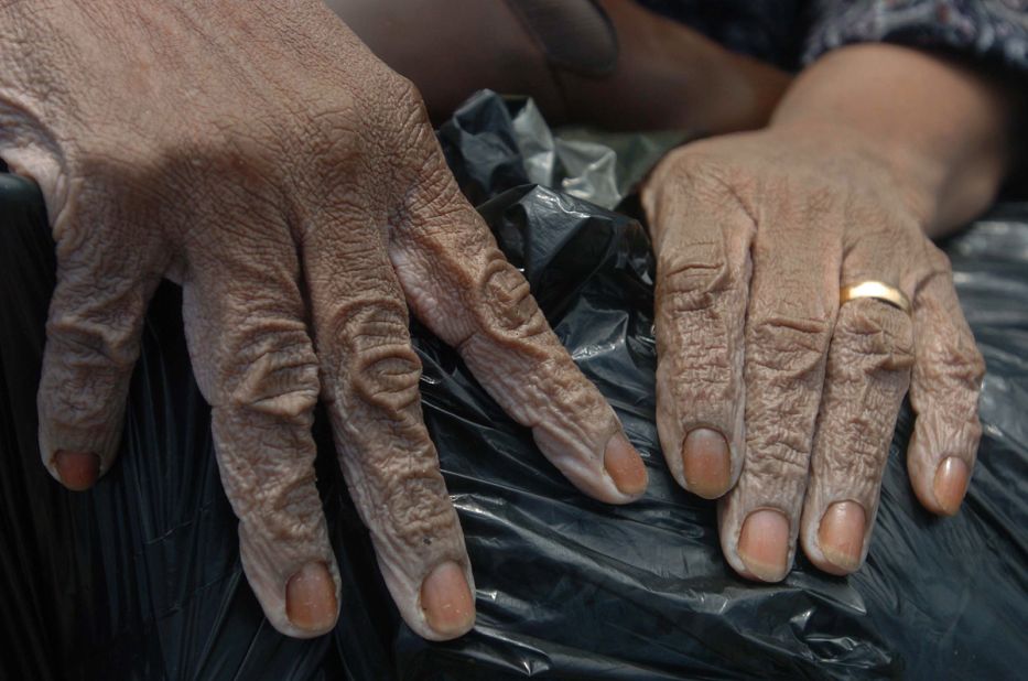 The hands of Shirley Ward, 40, are waterlogged after she was rescued on New Orleans' Rocheblave Street.