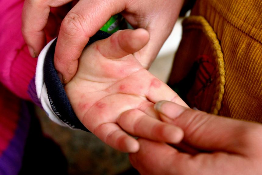 A child with hand, foot and mouth disease shows her palm at a local hospital in China.