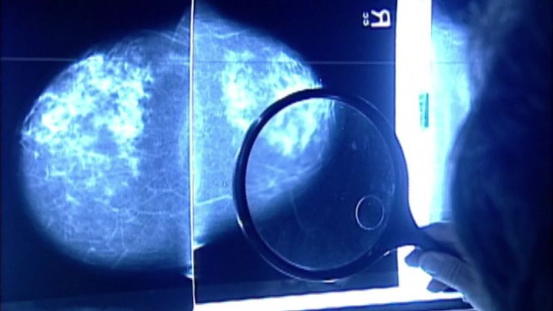 Targeted therapy shows benefit for people with advanced breast cancer in late-stage trial | CNN
