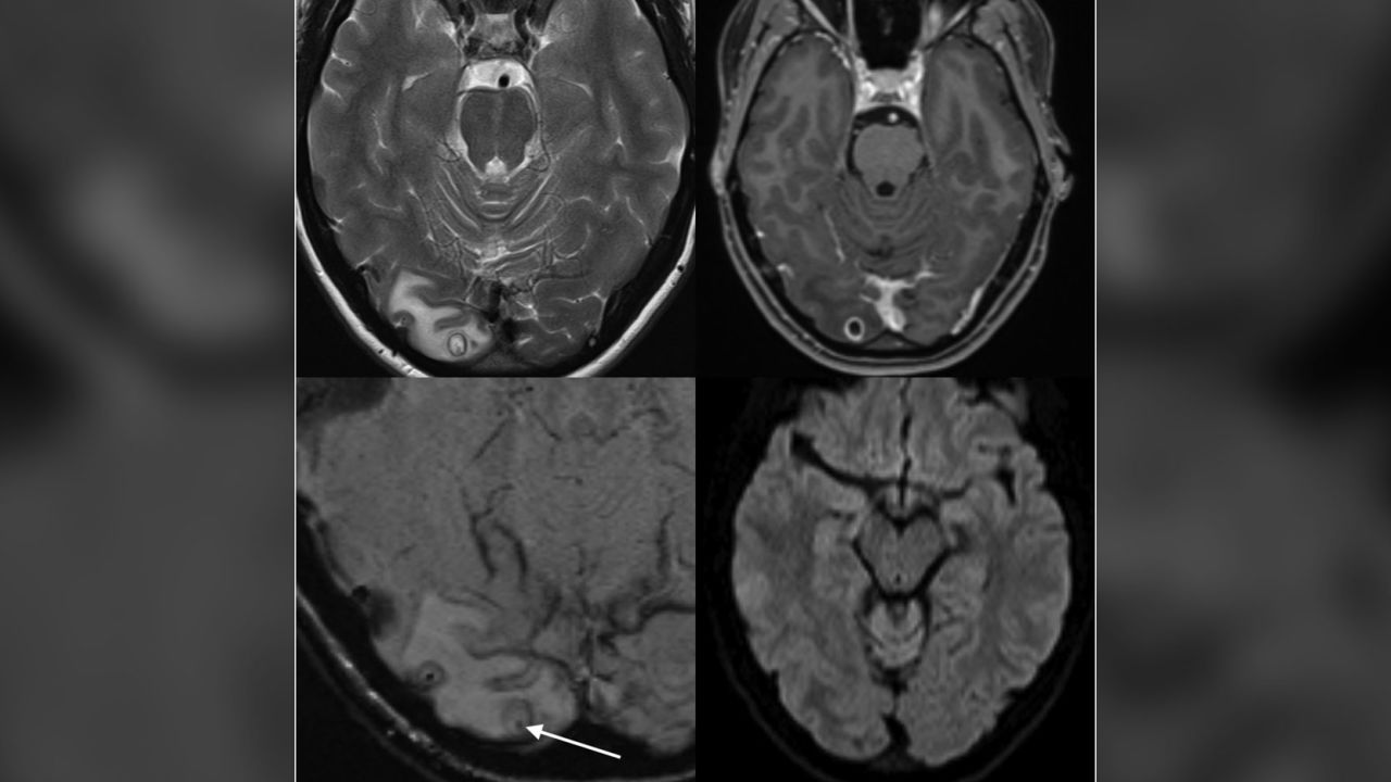 An MRI showed a cyst in the woman's brain which was found to contain tapeworm larvae. 