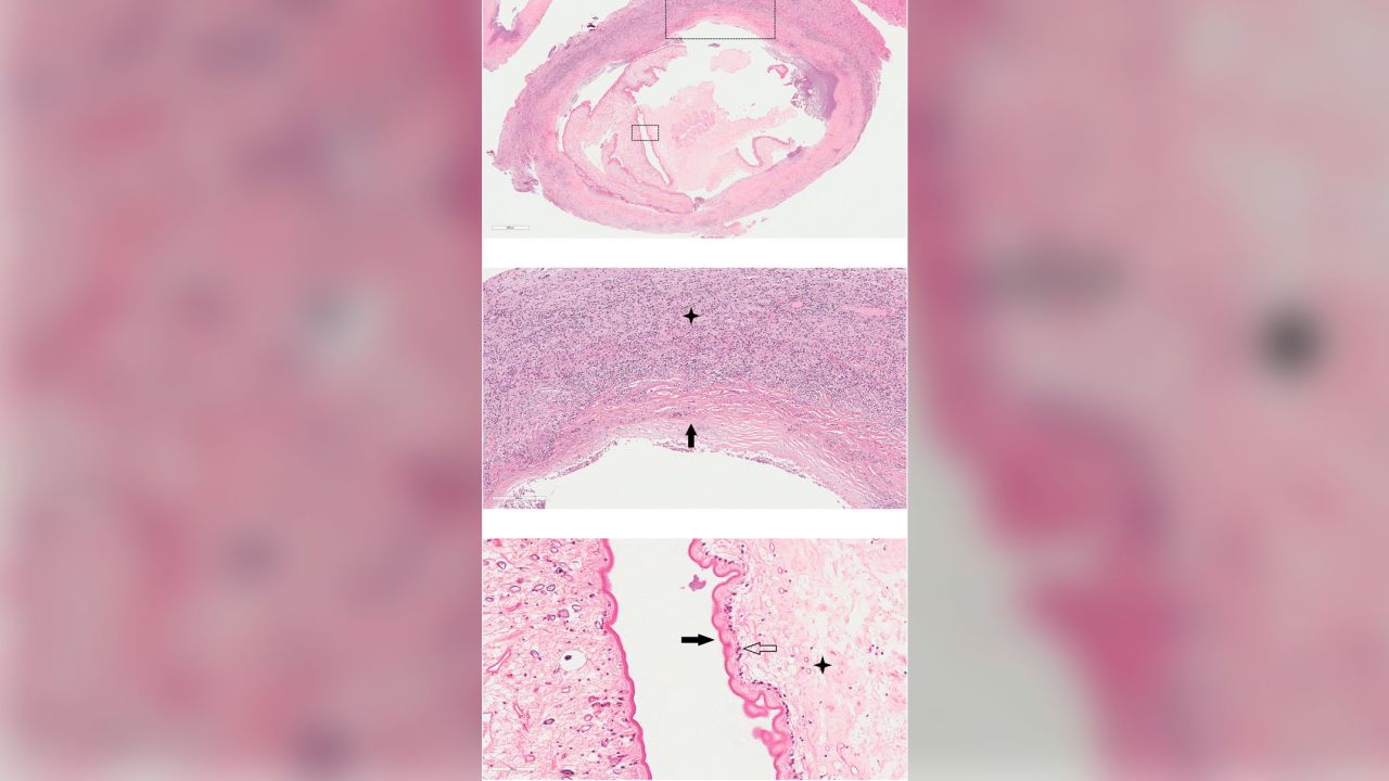 02 australia tapeworm headache brain trnd