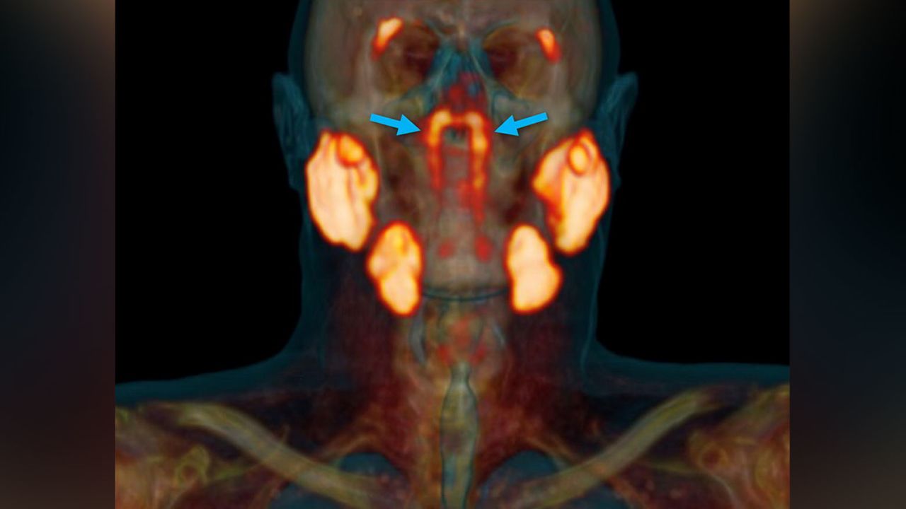 A specialized scan indicated a previously unnoticed pair of salivary glands in the human skull.