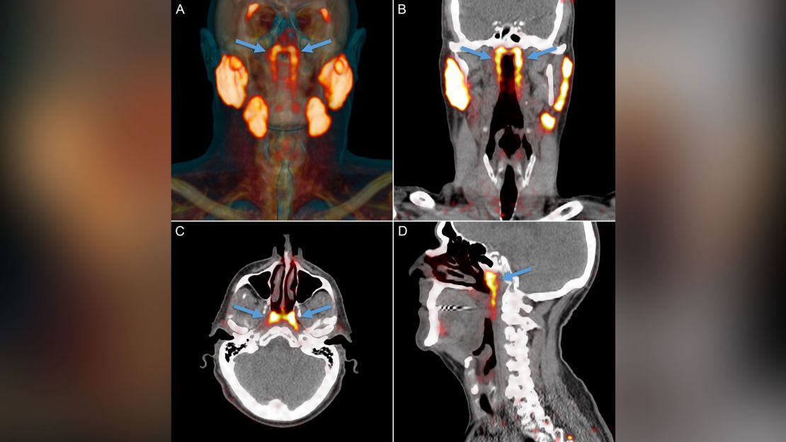 This overview of the salivary gland tissues as seen in PSMA PET/CT scans depicts the known major salivary glands and an unknown structure (indicated by arrows) in the nasopharynx showing similar imaging characteristics.