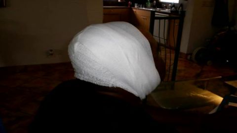 The victim's bandaged head after being mauled by a fully grown leopard.
