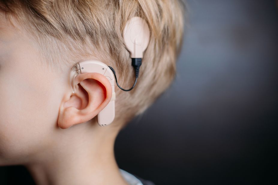 <a href="https://www.nidcd.nih.gov/health/cochlear-implants" target="_blank" target="_blank">Cochlear implants </a>can give a sense of sound to deaf people, by using electrodes to stimulate the auditory nerve. A rudimentary version was <a href="https://commons.erau.edu/cgi/viewcontent.cgi?article=3445&context=space-congress-proceedings" target="_blank" target="_blank">trialled in the 1950s</a>, and the idea was further developed by Adam Kissiah, a hard-of-hearing engineer at Kennedy Space Center. He had worked on sound and vibration sensor systems for <a href="https://www.nasa.gov/centers/kennedy/news/releases/2002/release-20020913.html" target="_blank" target="_blank">NASA in the 1970s </a>and used his knowledge to develop the life-changing implant.