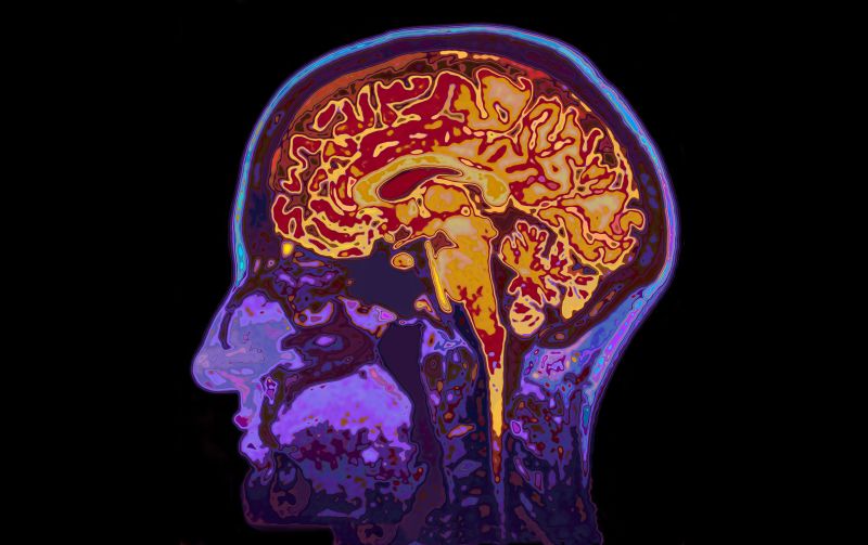 Alzheimer’s drug slows progression of cognitive decline in clinical trial drugmakers say – CNN