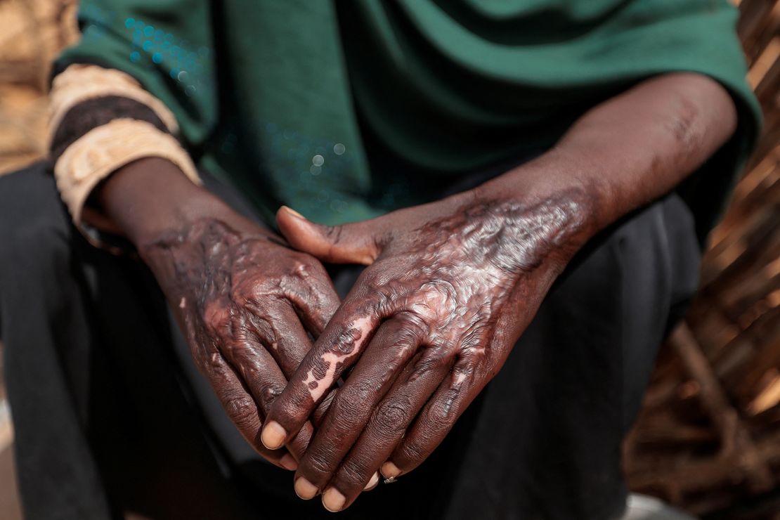 A Sudanese woman, pictured on August 5, 2023 at her makeshift shelter in Adre, Chad, shows burn scars on her hands that she said she sustained in April 2023, after Rapid Support Forces (RSF) and Arab militia forces torched the displaced-persons camp where she was living in El Geneina.