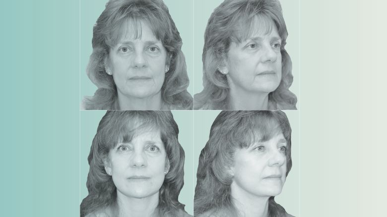 20250801-ozempic-face-FINAL.jpg