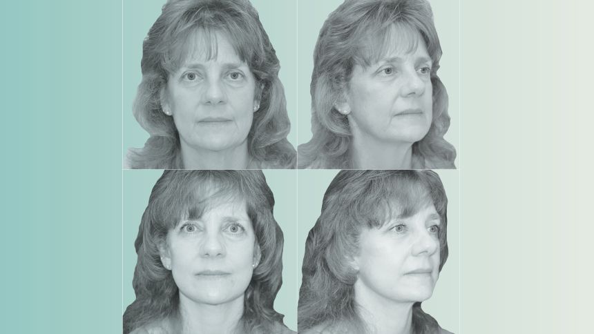 ‘Ozempic face’ is also using a plastic surgery increase | The Gentleman Report