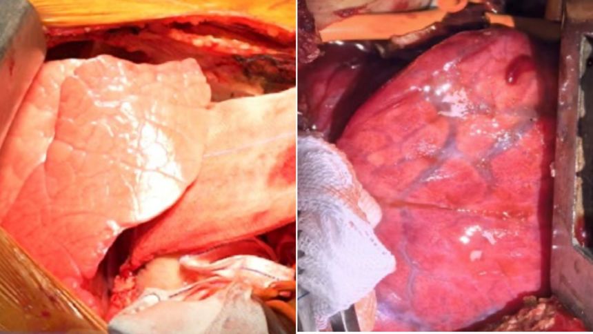 Photographs show the pig lung right after it was transplanted and four days later.