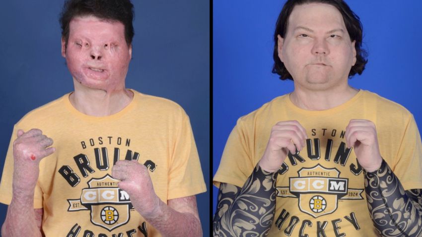 Joe DiMeo Face Hand Transplant Before And After