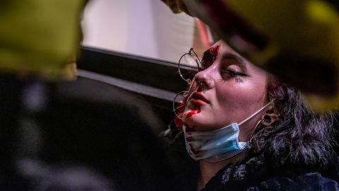 A woman after being hit in the eye by a projectile on Tuesday.