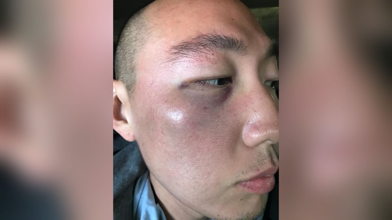 Denny Kim says two men yelled racial slurs and struck him in the face.