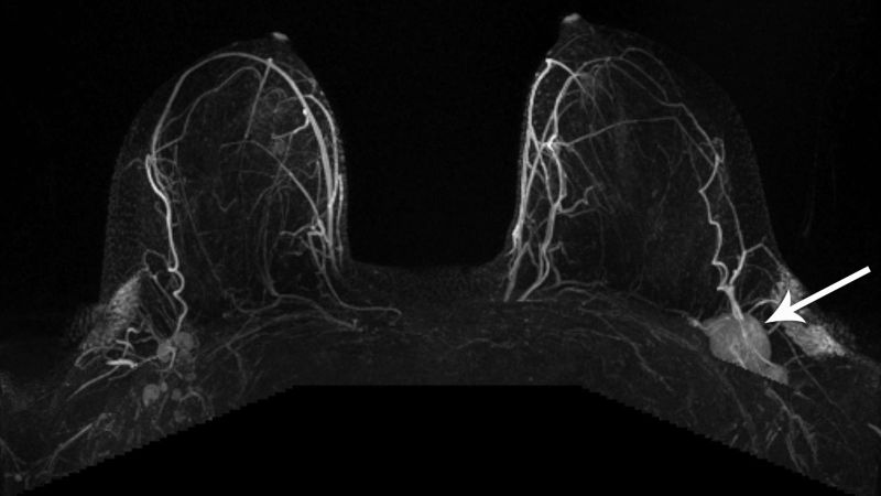 Mammograms pick up swelling related to the Covid 19 vaccine study