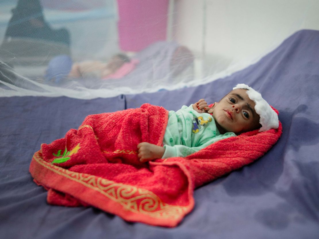 Mohammed, a severely malnourished 6-month old, at the Therapeutic Centre in Abs Hospital.