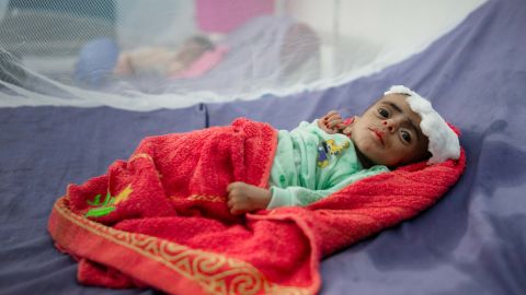 Mohammed, a severely malnourished 6-month old, at the Therapeutic Centre in Abs Hospital.