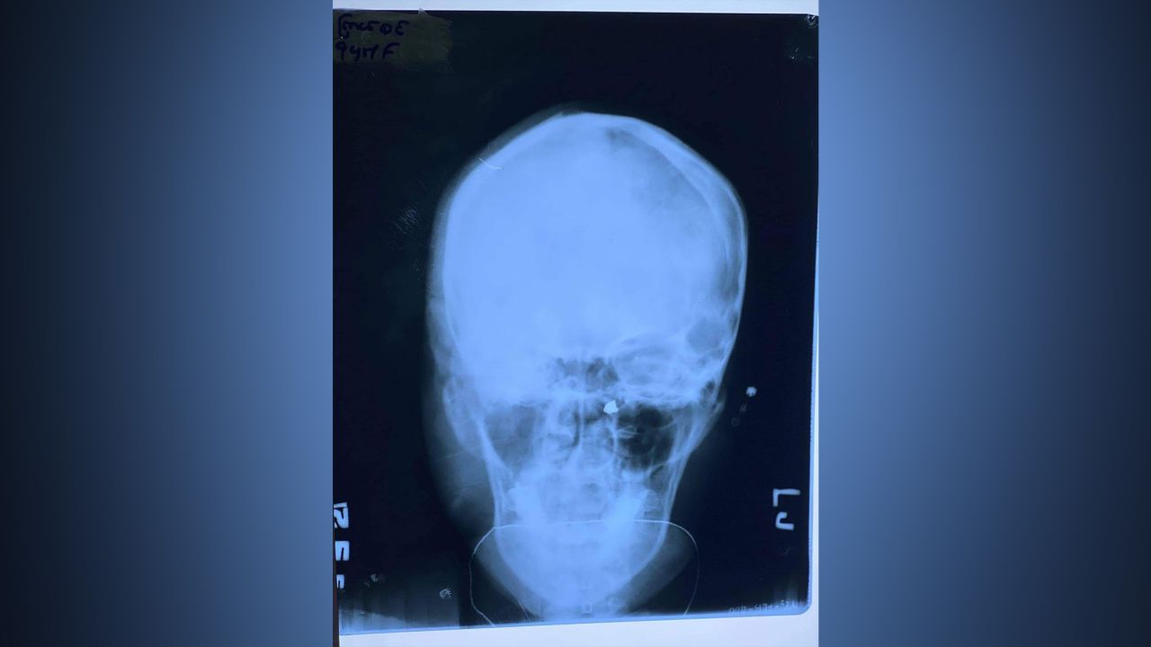 An x-ray of Ma Kyal Sin's skull after she was killed. The primary cause of death was brain injury caused by gunshot wound, said the doctor, who didn't want to be named for security reasons.