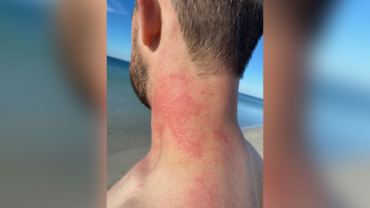 Lance Karlson was left with the imprint of an octopus tentacle after being attacked in Geographe Bay in Western Australia on March 18.