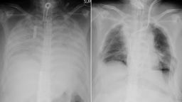 X-ray images show the patient's chest before the transplant operation, left, and after, right. The dark areas indicate where lung tissue has been transplanted. 